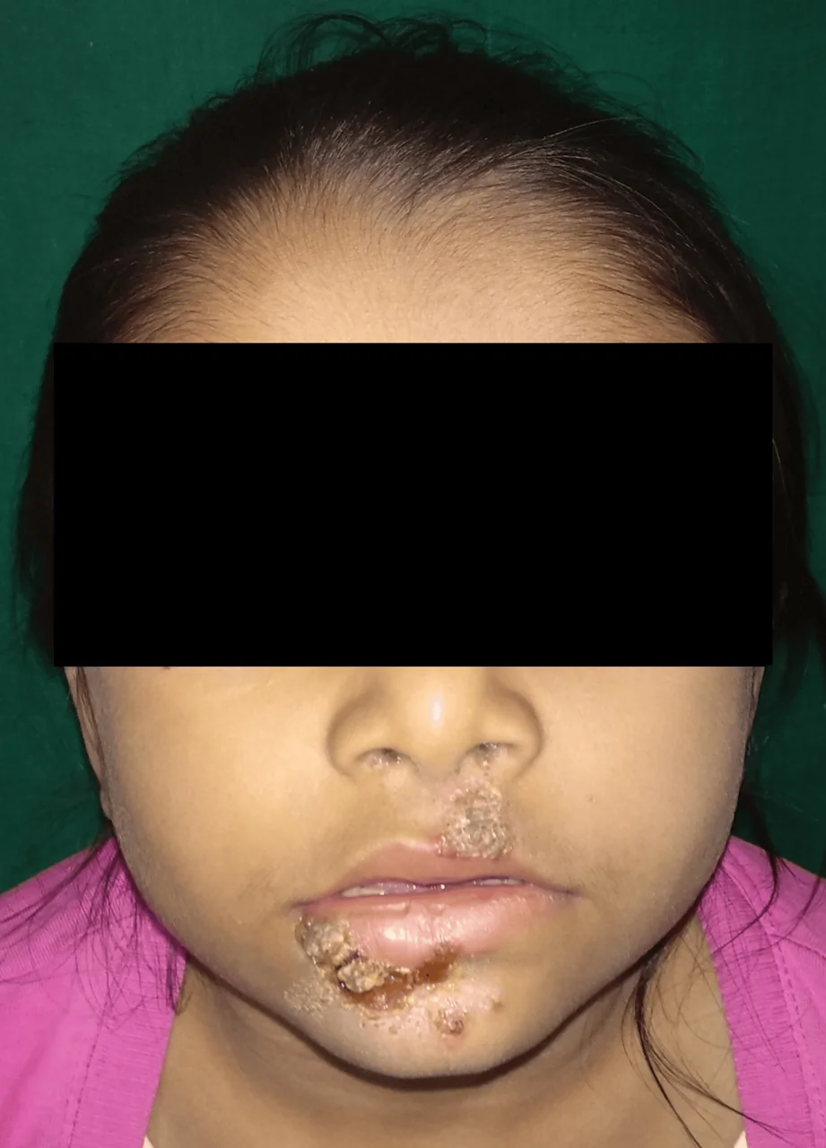 코·입 주변에 노란 딱지가 생긴 농가진 사례(2025년 공개 논문, 연구 기간 2019~2020년). 원본의 눈 가림을 유지했습니다. 모든 딱지나 물집이 농가진은 아니며 사진만으로 진단하지 않습니다.