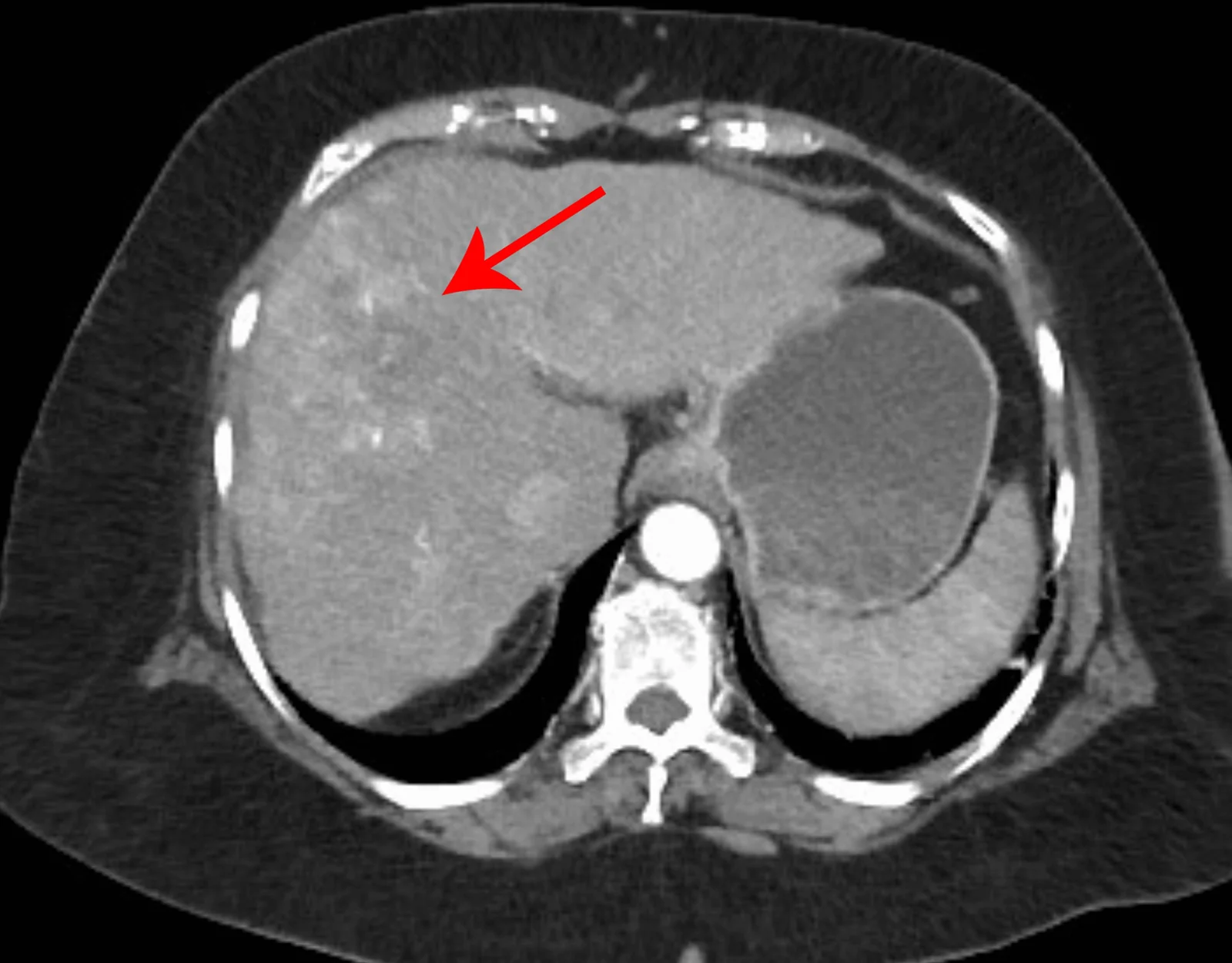 간경변이 있는 간세포암 환자의 조영증강 CT 동맥기 영상입니다. 붉은 화살표는 조영되는 간 병변을 가리킵니다(2025년 논문 공개, 촬영일 미상). 원문 진단은 다른 조영 시기의 영상과 임상 정보를 함께 평가한 결과이며, 이 한 장만으로 간암이나 전이를 진단할 수 없습니다.