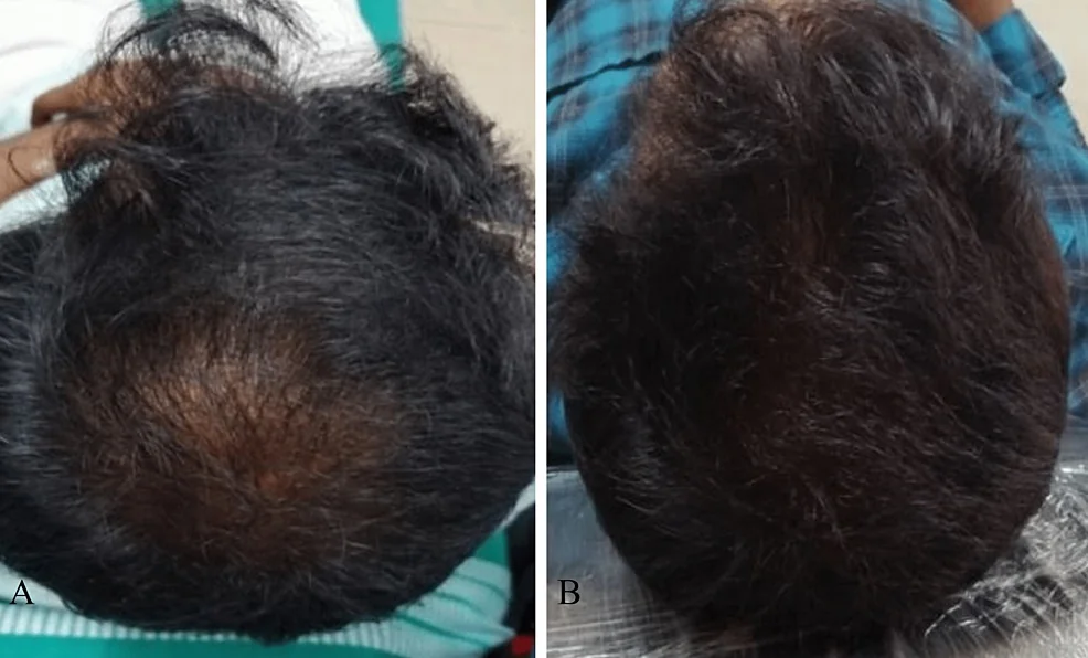 남성형 탈모 환자 한 명의 정수리 사진으로, A는 연구 시작 전이고 B는 혈소판풍부혈장(PRP) 네 차례 시술 후입니다(2023년 논문 공개, 촬영일 미상). 원본 비교 패널을 그대로 실었으며 특정 시술을 추천하거나 같은 효과를 보장하는 사진이 아닙니다. 조명·머리 상태도 달라 사진만으로 치료 효과를 평가할 수 없습니다.