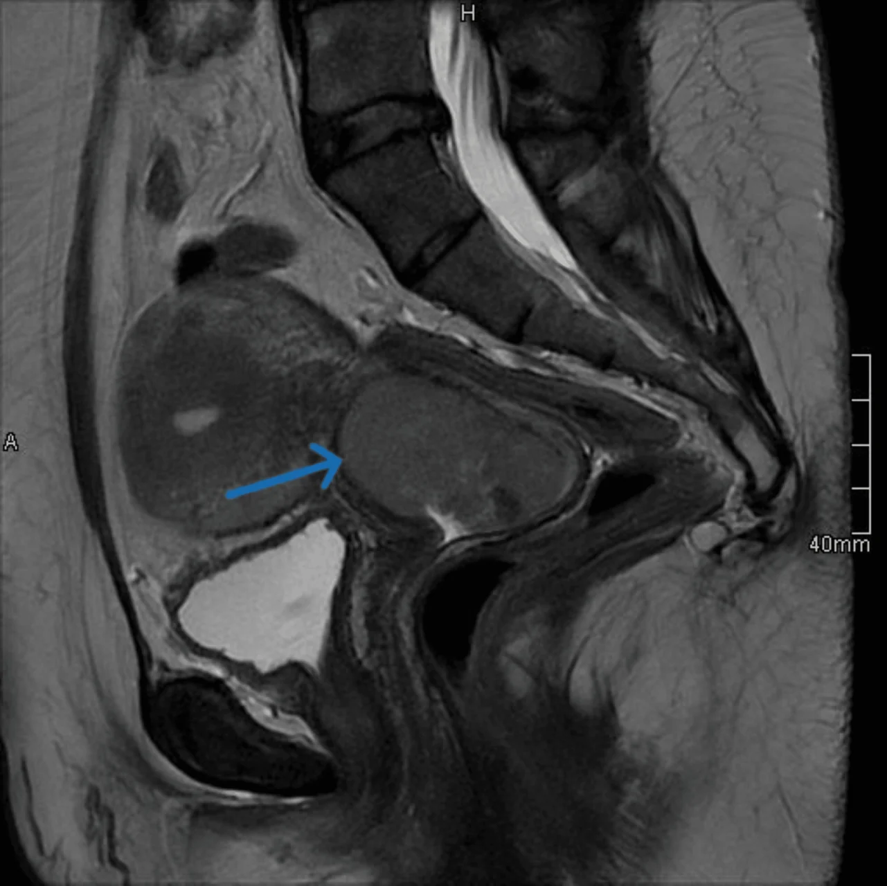 2025년 공개 논문에서 조직검사로 자궁경부 편평세포암이 확인된 환자의 골반 MRI. 자궁경부 종괴가 보이는 치료 전 영상입니다. 한 환자의 검사 사례로, 모든 자궁경부암이 같은 크기나 모양은 아니며 사진으로 암을 스스로 판정할 수 없습니다.